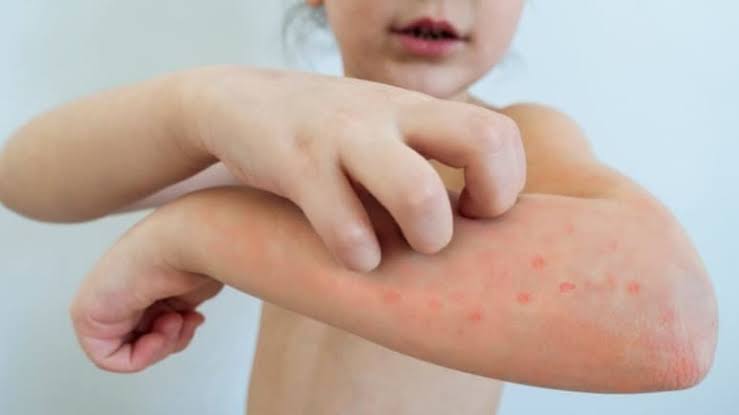 Aumentan 144% casos de varicela en Tabasco