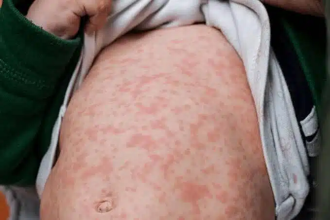 Tabasco registra 29 casos probables de sarampión; sólo uno ha sido confirmado