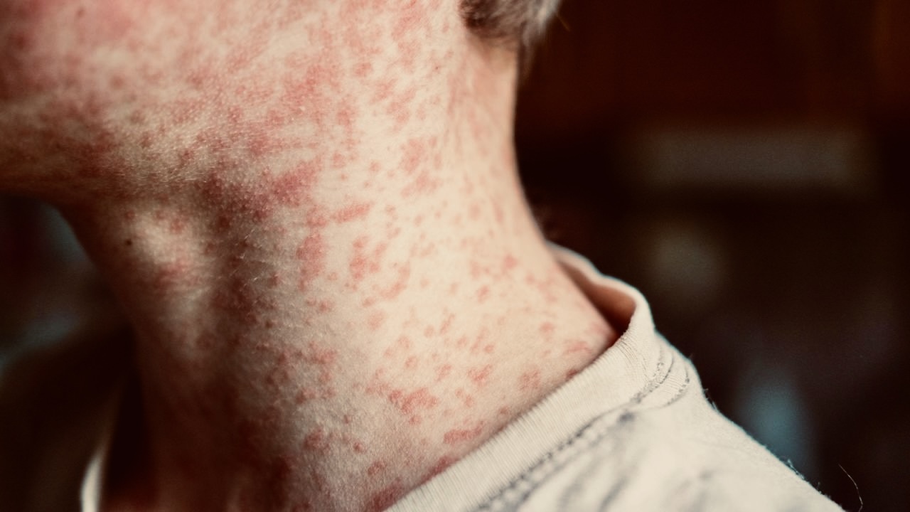 México suma 31 muertes por Sarampión